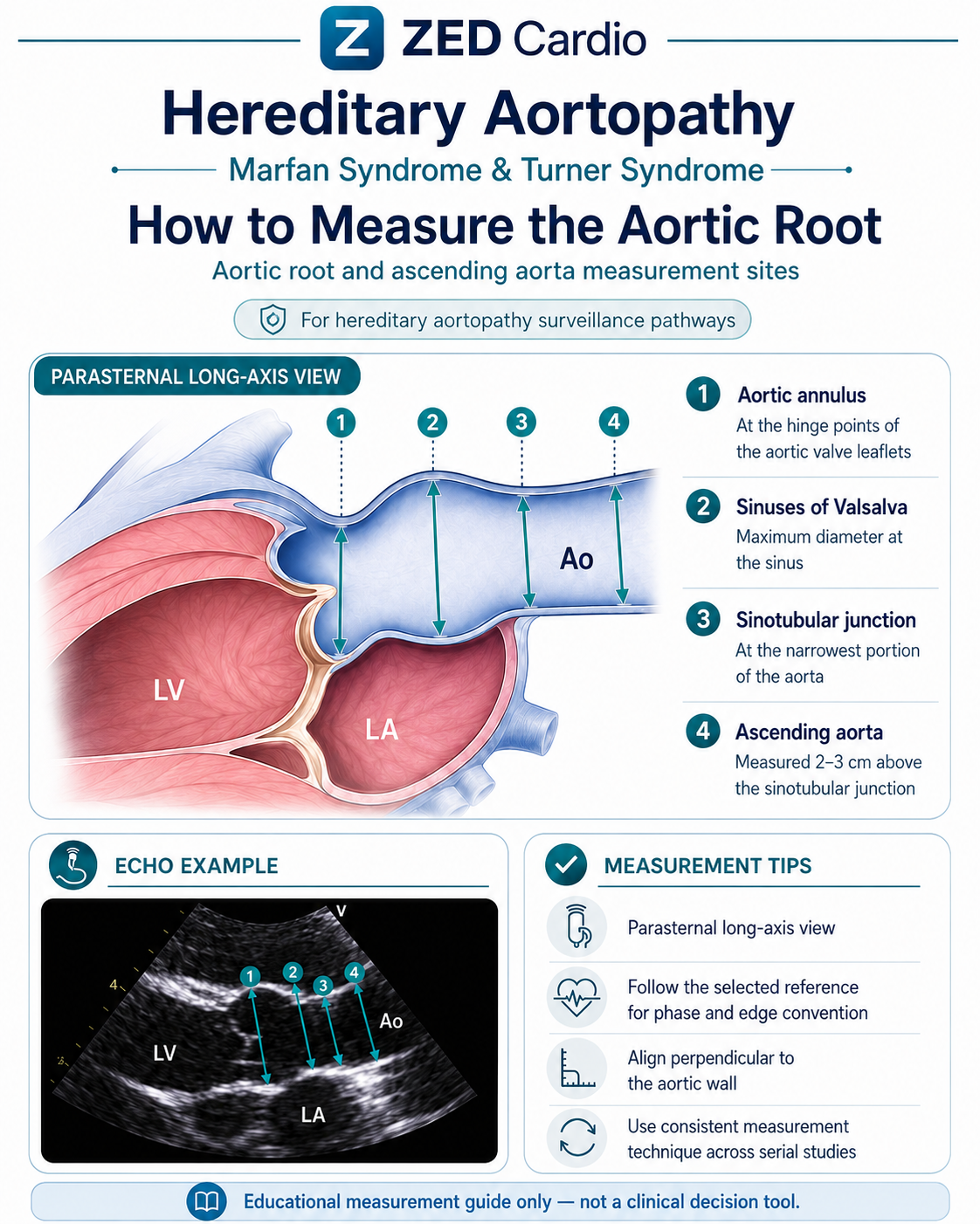 Aortic root and ascending aorta measurement sites for Marfan and Turner syndrome surveillance.